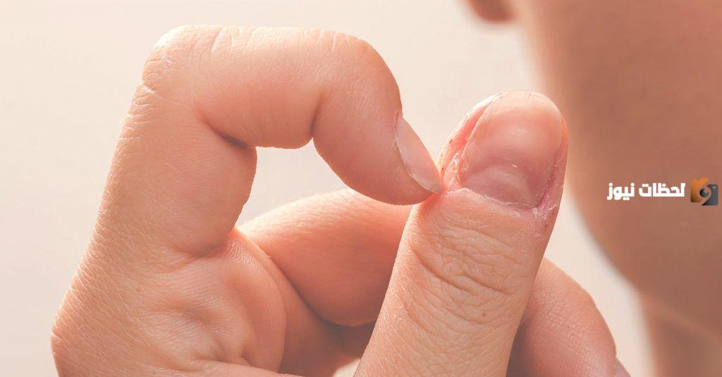 ما هي اسباب قضم الأظافر عند الأطفال وطريقة علاجها