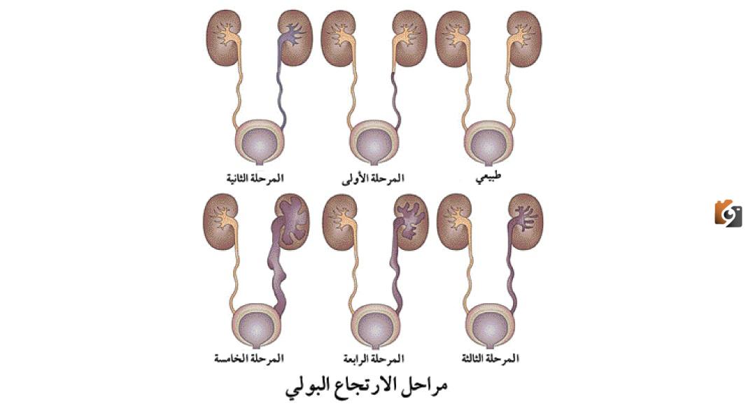 ما هي اضرار الارتجاع البولي المثاني الحالبي عند الأطفال