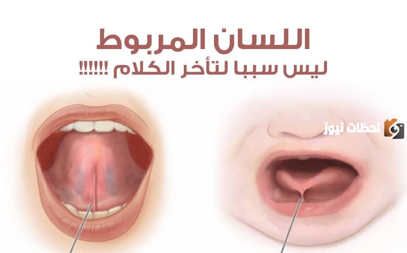 ما هي مشكلة اللسان المربوط عند الأطفال