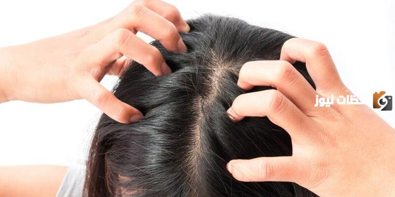 وصفة سهلة للتخلص من قشرة الشعر