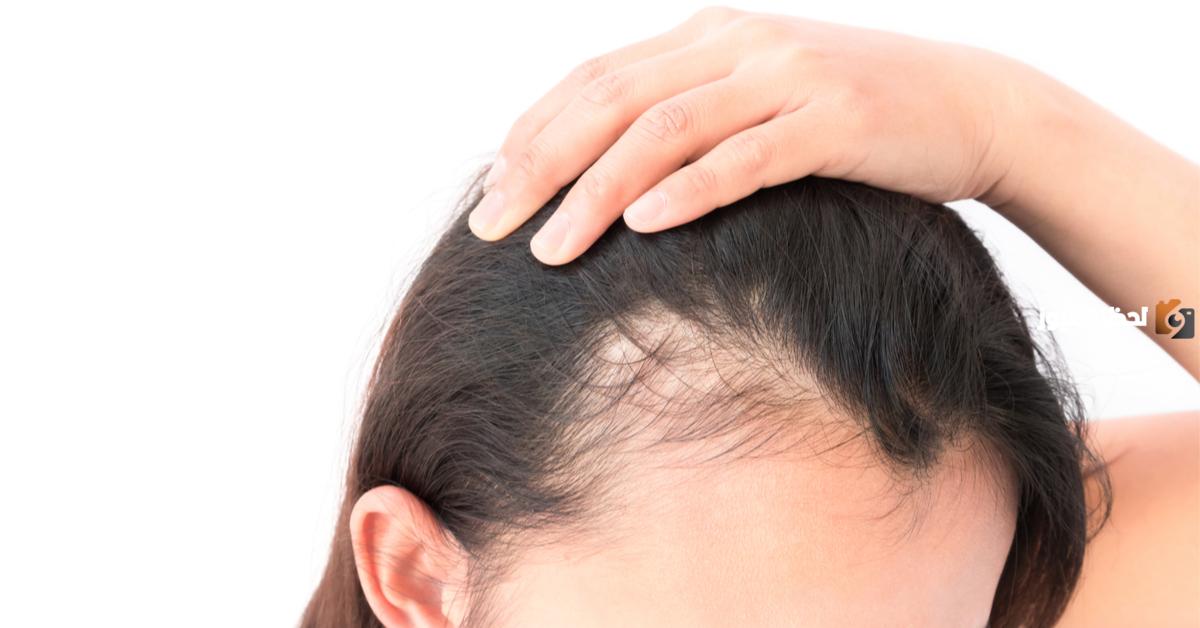 وصفة نبت شعري بعد الصلع