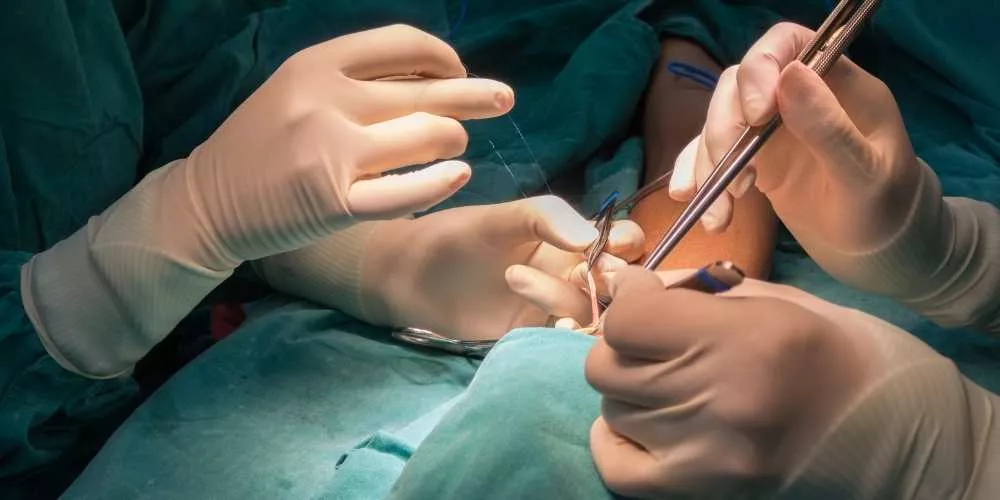 كيف تتم عملية الناسور المستقيمي المهبلي