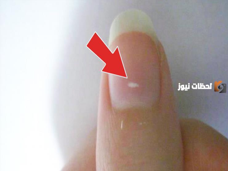 ما سبب اللون الأبيض في الأظافر
