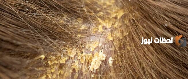 ما هو علاج قشرة الشعر الدهني