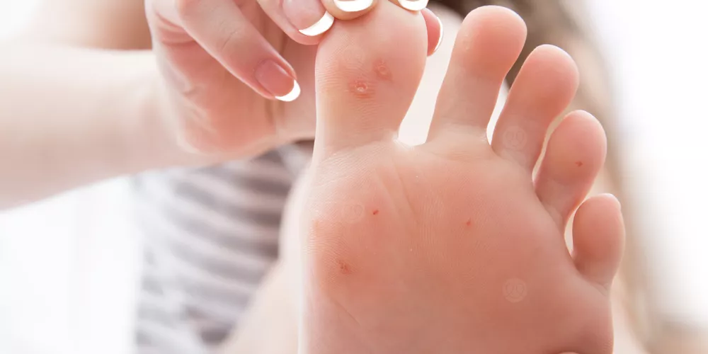 هل تختفي عين السمكة؟