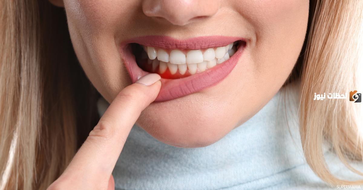 كيفية تقوية اللثة في المنزل بوصفات طبيعية
