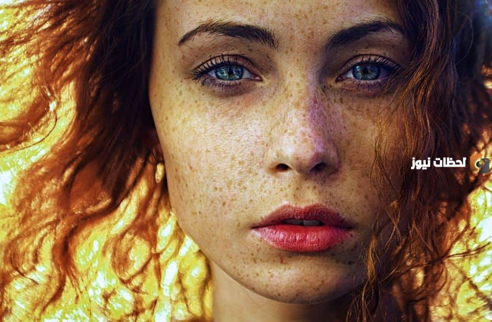 ما هي أفضل وصفات لإزالة النمش من البشرة وأسباب ظهور النمش