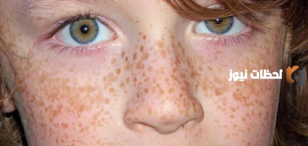 إليك مجموعة من وصفات لعلاج الكلف والنمش