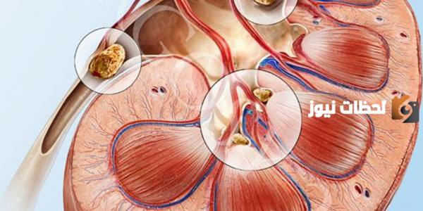 علاج دوالي الخصية