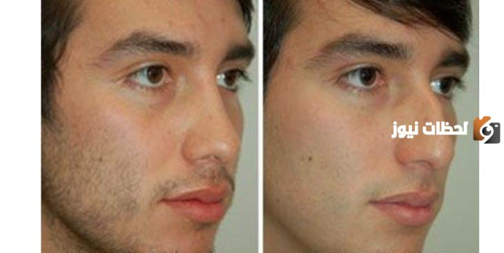 تكلفة عملية تجميل الأنف في مستشفى الحبيب السعودي