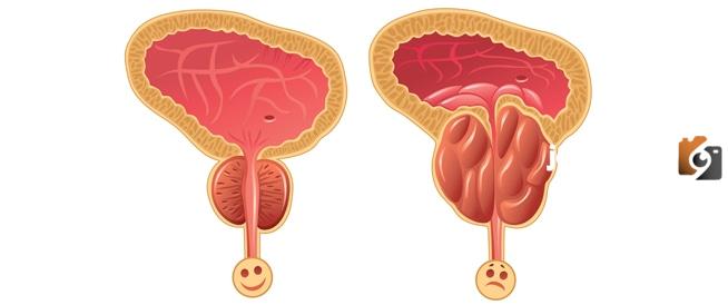علاج تضخم البروستاتا بالاعشاب