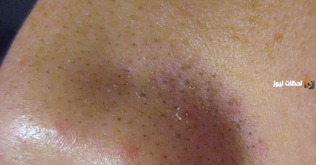 طرق التخلص من الرؤوس السوداء بطريقة صحيحة