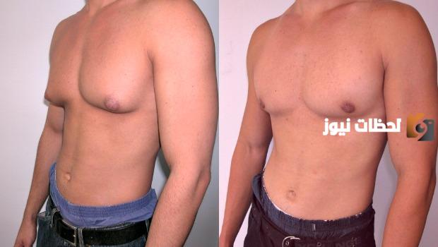 علاج تصغير الثدي عند الرجال بالأعشاب بطريقة سريعة ومضمونة عن تجربة