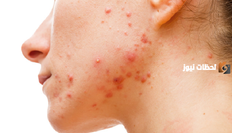 هل ظهور الحبوب من علامات خروج العين