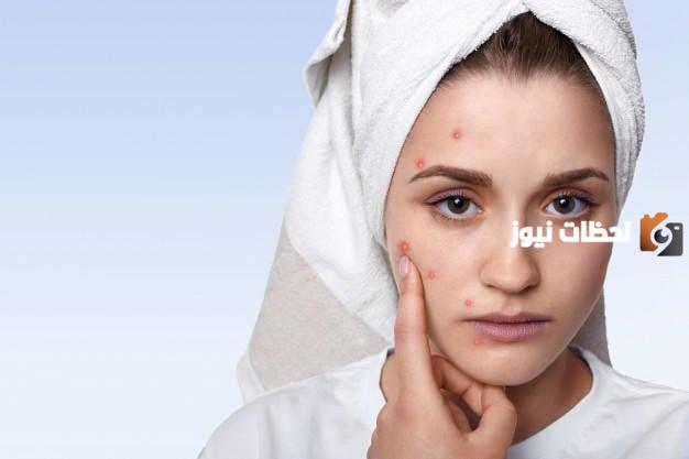 إليك تجربتي في ازالة حب الشباب نهائيًا