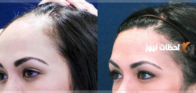 كيف تتم زراعة الشعر 