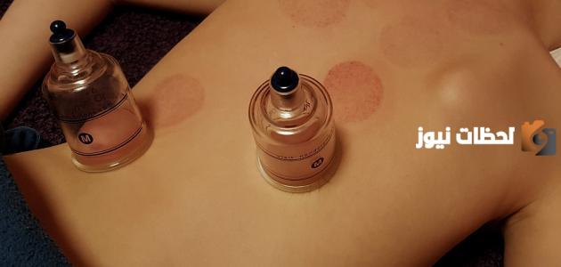 حكم الحجامة في رمضان