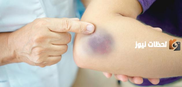 سبب ظهور كدمات في الجسم