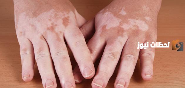 متى اليوم العالمي للبهاق