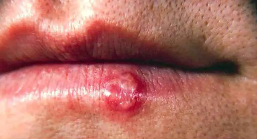 أسباب ظهور لطمة الحمى