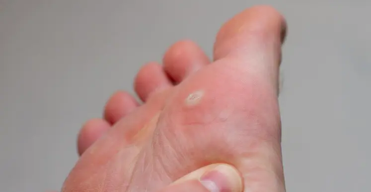 أشكال عين السمكة