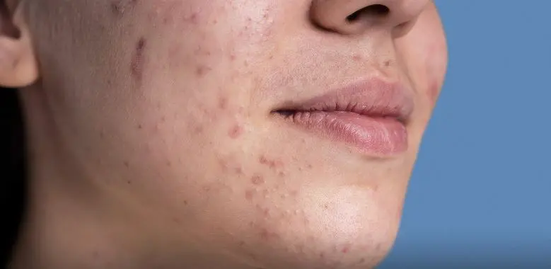 أصعب أنواع البشرة