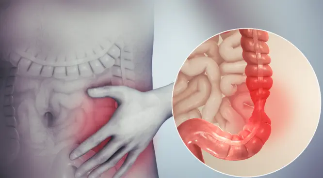 أعراض القولون العصبي المتهيج