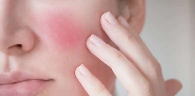 البشرة الحساسة والجافة