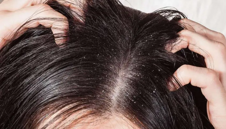 التخلص من القشرة نهائياً للنساء