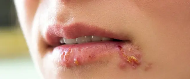 ظهور لطمة الحمى في الفم