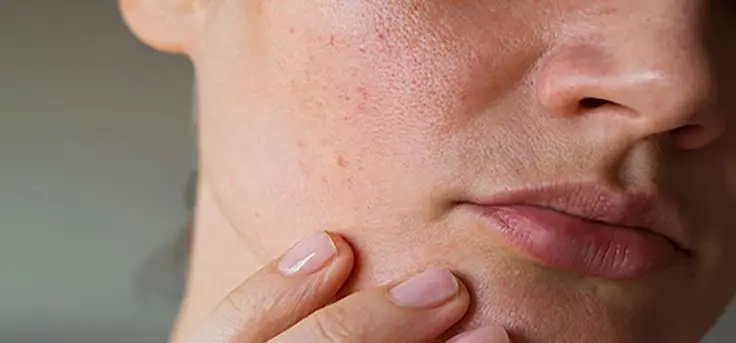 عدم ترطيب الوجه