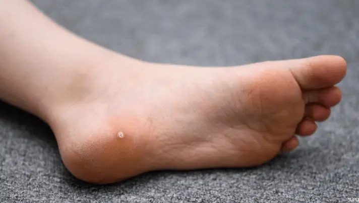 علاج عين السمكة