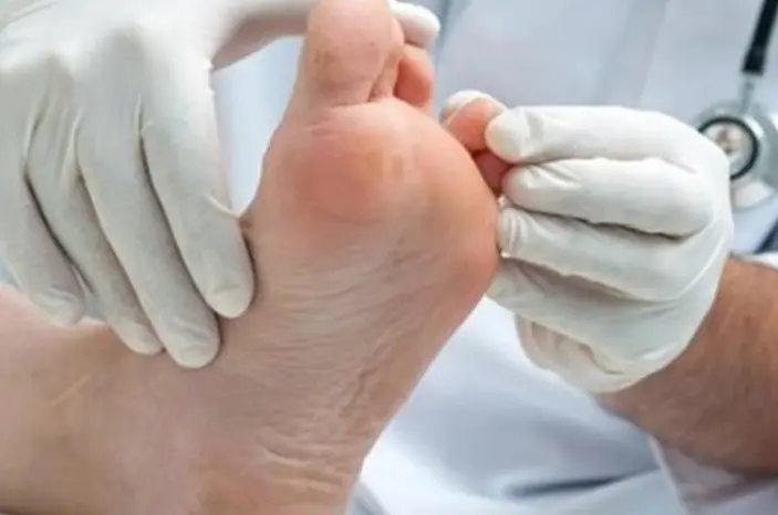 علاج عين السمكة