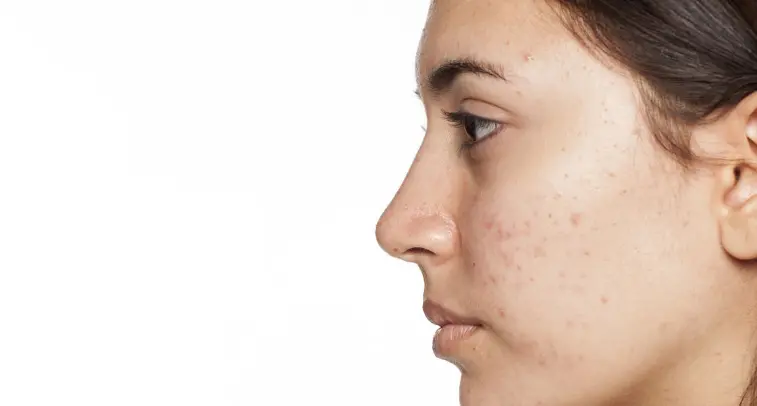 على ماذا تدل الحبوب في الوجه