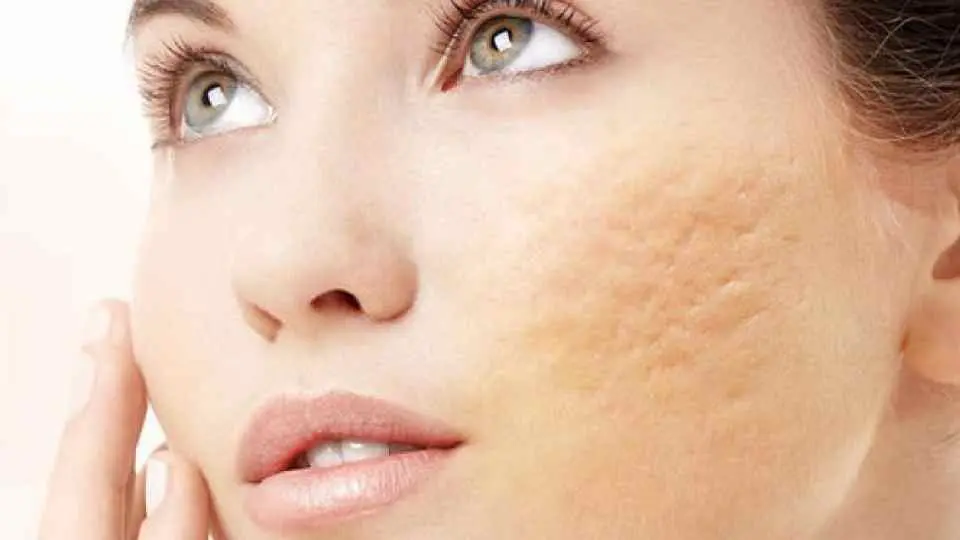 كيفية إزالة ندوب الوجه