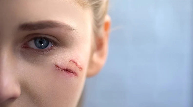 كيفية إزالة ندوب الوجه