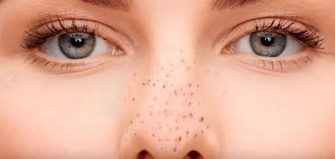 كيف ازيل الرؤوس السوداء من الانف