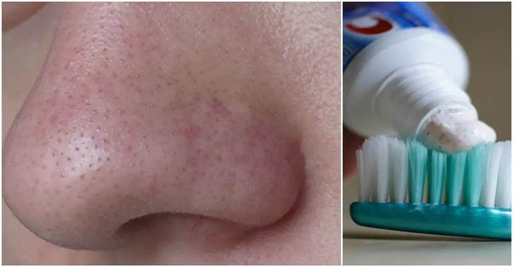 كيف ازيل الرؤوس السوداء من الانف