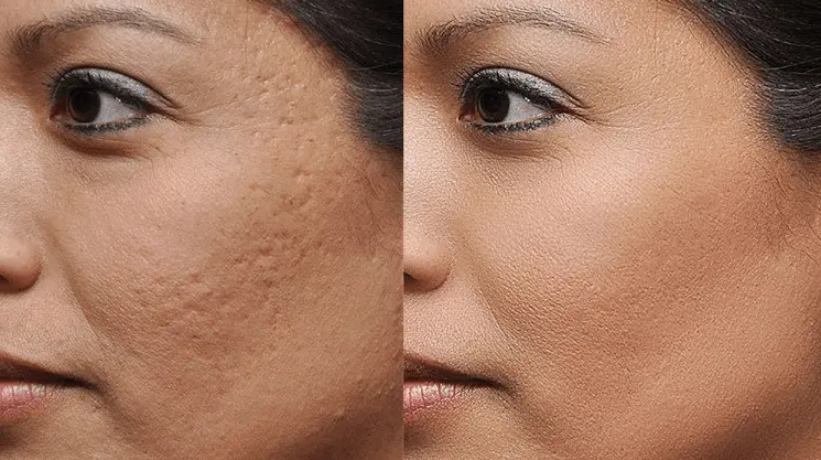 ماذا يحدث بعد إزالة ندوب الوجه