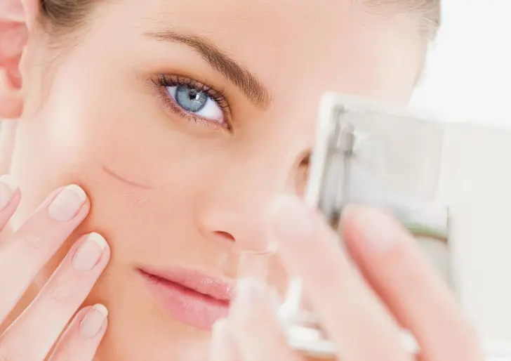 مخاطر إزالة ندوب الوجه بالتقشير