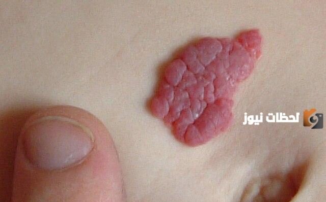 ما هي الأورام الوعائية عند الأطفال