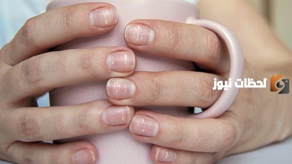 أسباب النقط البيضاء في الاظافر
