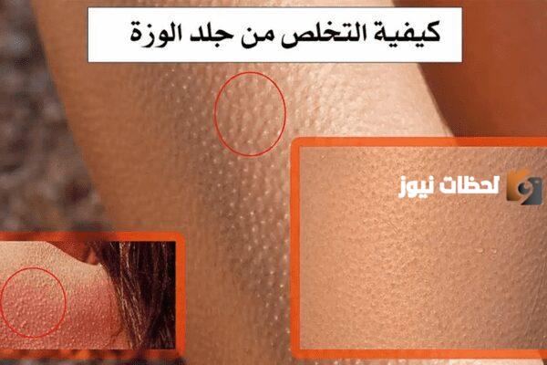 إليك كريم اكرتين لعلاج جلد الوزة