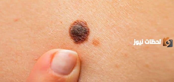 كيف يبدأ سرطان الجلد