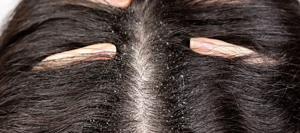 ما هو علاج قشرة الشعر الدهني