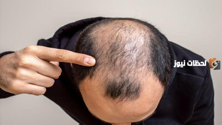 ما هى طريقة علاج الصلع المبكر عند النساء