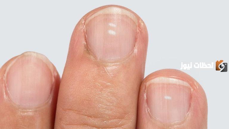ما سبب اللون الأبيض في الأظافر