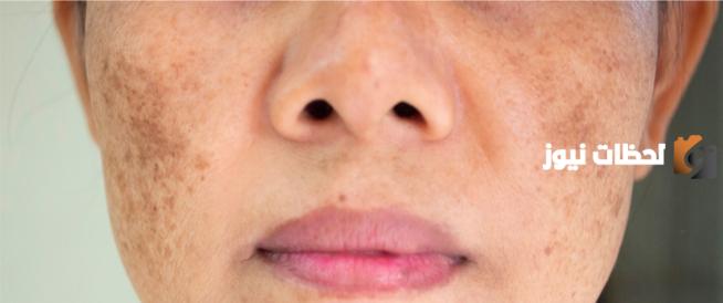 ما هو علاج البقع السوداء في الوجه عند الرجال