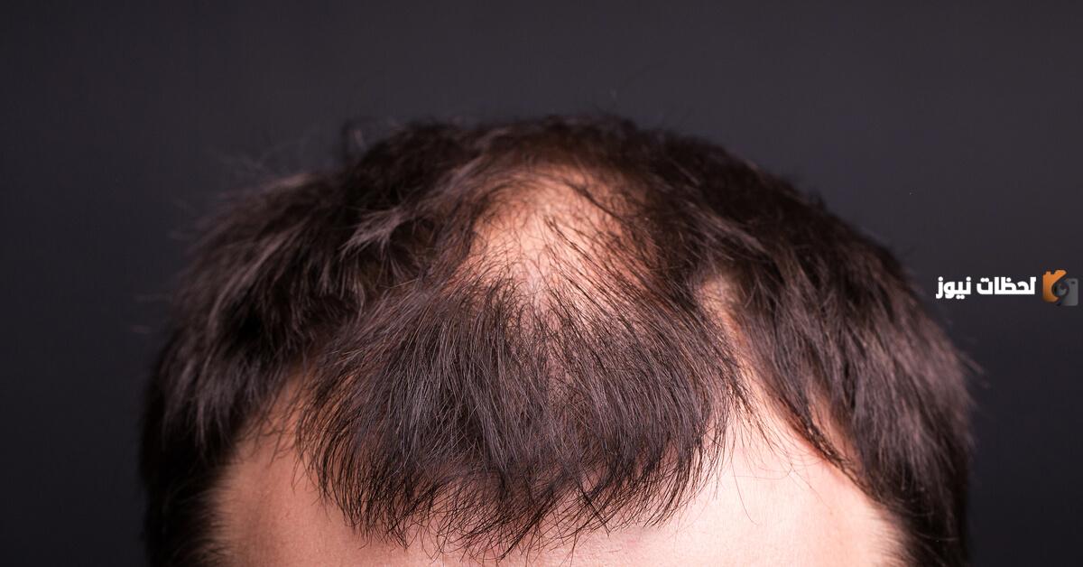 الصلع عند الرجال اسبابه وعلاجه