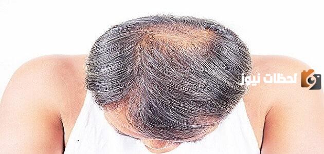 طريقة استخدام كامينوموتو تريجر لعلاج الصلع